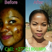 Skin Lightening Cream / Dark Spots/ Stretch Marks 